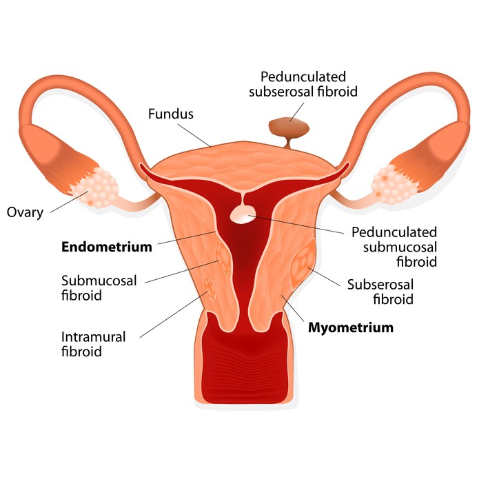 uterine fibroid illustration