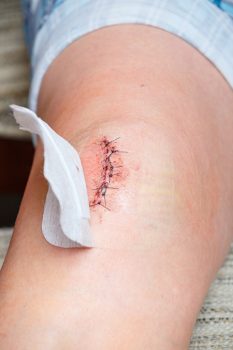 knee surgery scar
